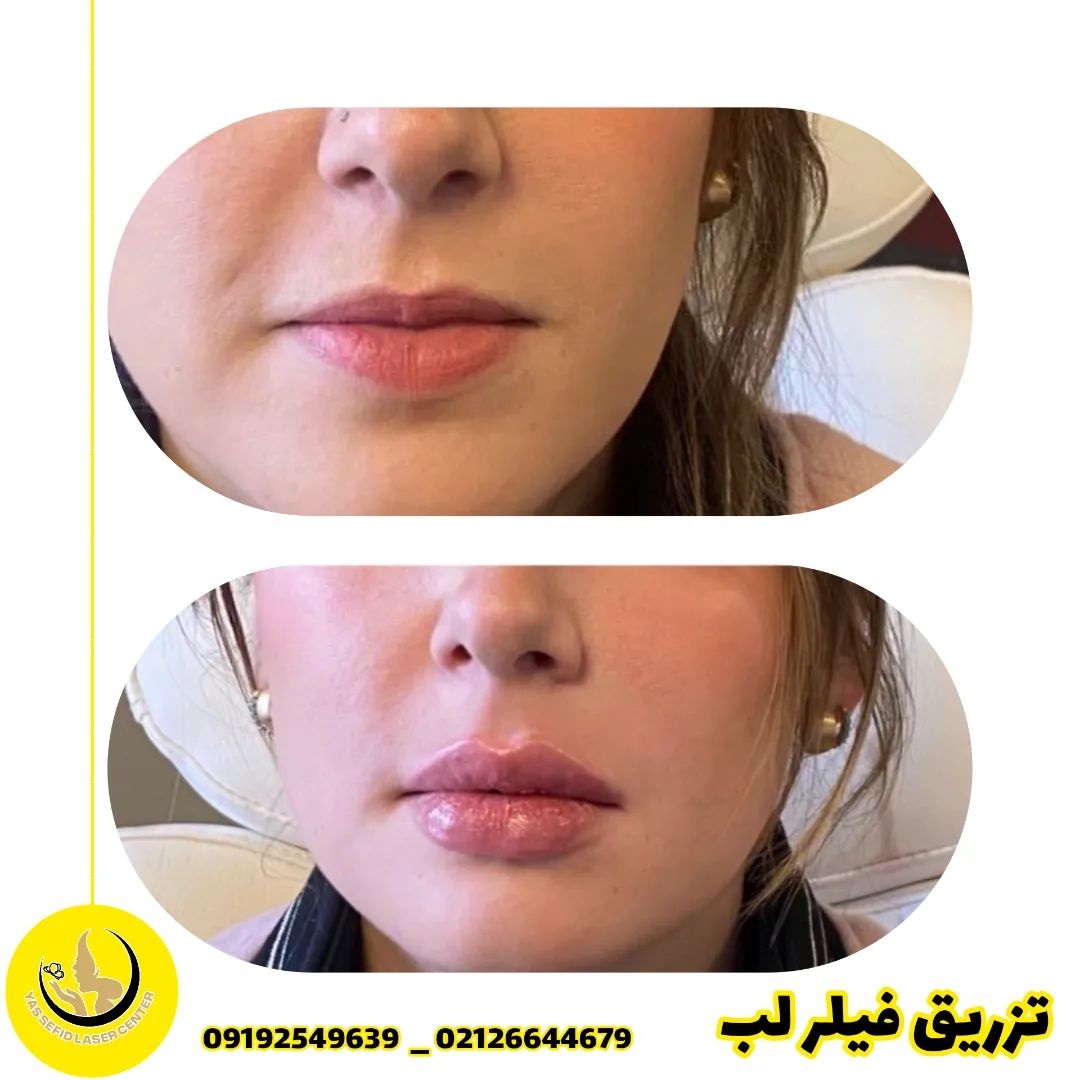 بهترین فیلر برای لب کدام است