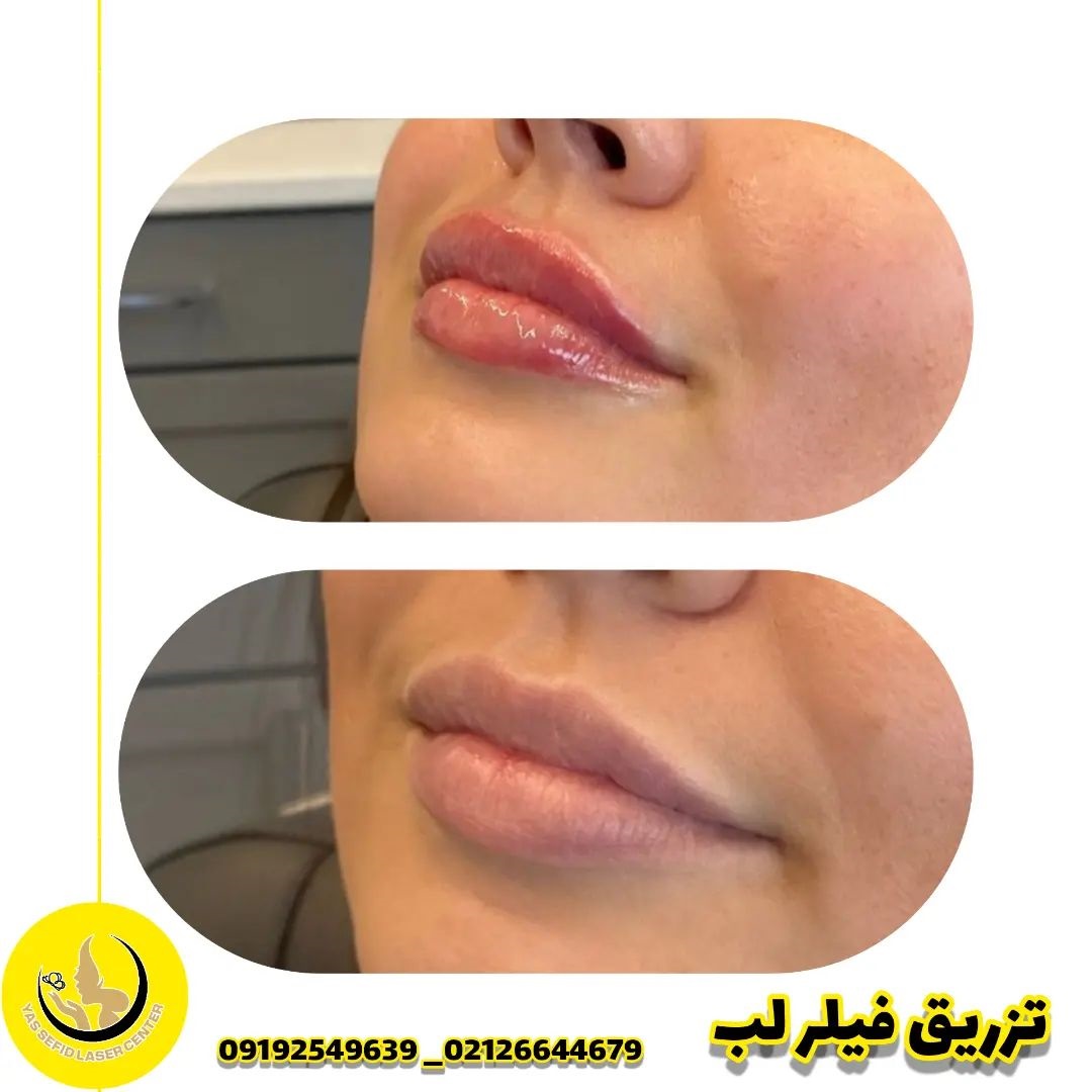 بهترین دکتر برای تزریق فیلر در شریعتی