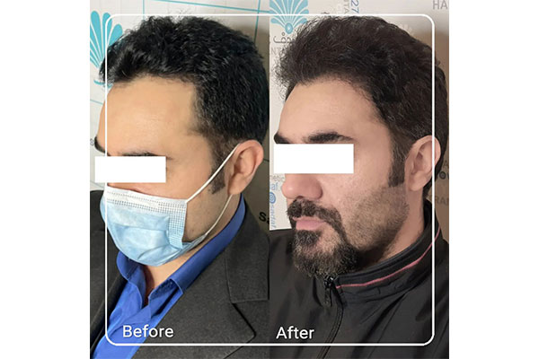 کاشت تخصصی مو در میرداماد