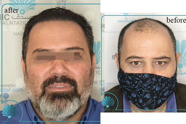 مراحل کاشت مو