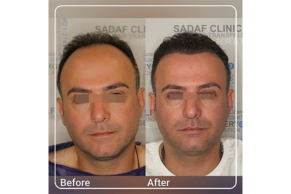 بهترین مرکز کاشت مو در میرداماد