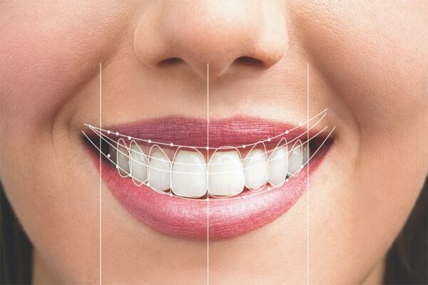 مراقبت های لازم بعد از لمینت دندان شامل چه مواردی می شود؟