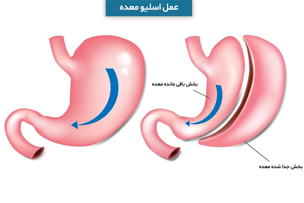 اسلیو معده چیست؟