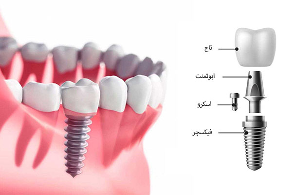 مهمترین مزایای ایمپلنت نسبت به سایر روش ها