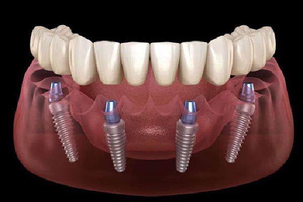 ایمپلنت دندان در کلینیک دندانپزشکی مهر نو