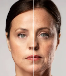 تفاوت های کلیدی جالپرو و پروفایلو در درمان جوانسازی پوست