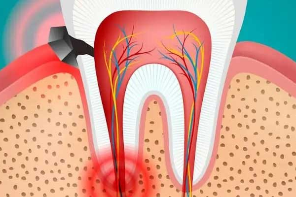 روش های موثر در درمان دندان درد