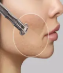 مزایا و نکات مهم در استفاده از میکرودرم ابریژن