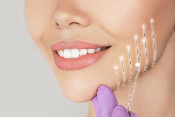 انواع نخ ها برای لیفت صورت