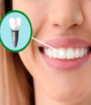 بررسی علل شکست ایمپلنت دندانی و روش‌های افزایش دوام آن