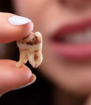 چگونه پوسیدگی دندان را درمان کنیم؟ معرفی بهترین روش‌ها و نکات کلیدی