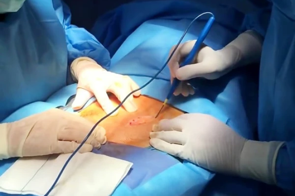 روش های درمان واریکوسل کدامند؟