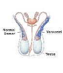 روش‌های نوین درمان واریکوسل، از دارو تا جراحی