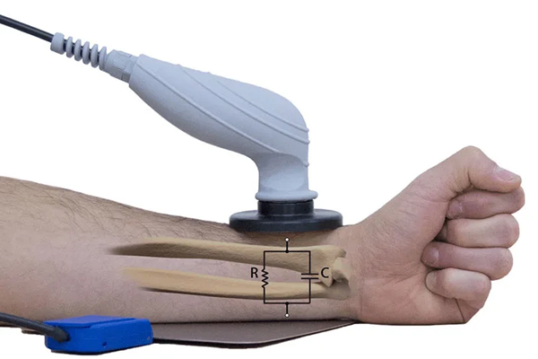 مزایای ترکیب شاک ویو و تکار تراپی