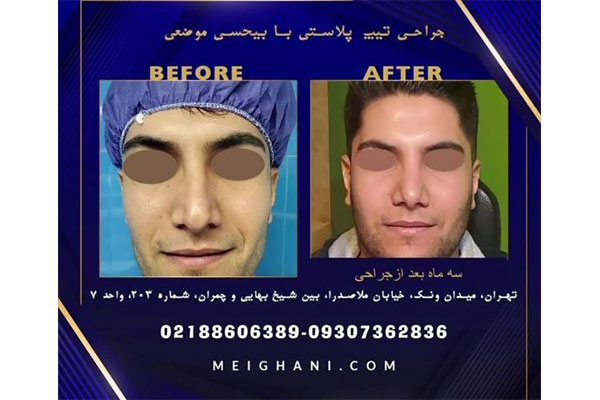 جراحی بینی با بیحسی موضعی در ونک