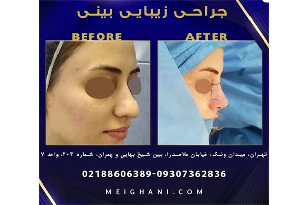 جراحی بینی طبیعی در ونک