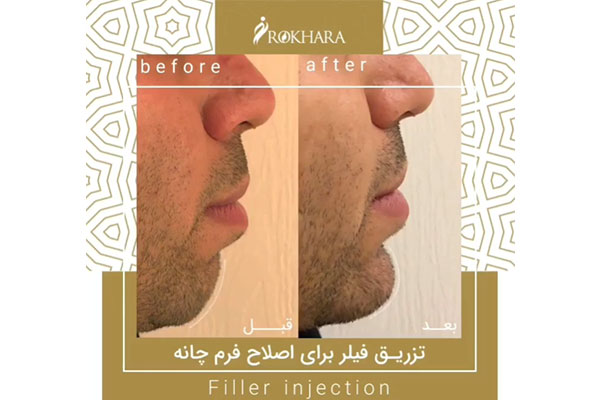 مزیت های فیلر پرفکتا