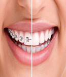 با ارتودنسی (ثابت و متحرک) در  کلینیک دندانپزشکی دکتر سمانه حسینی زیبایی را به دندان هایتان بازگردانید