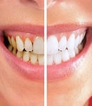 با بلیچینگ و پولیش دندان در ویکتوری دنتال کر دندان هایی درخشان داشته باشید