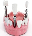 هر آنچه باید درباره ایمپلنت دندان بدانید،ویکتوری دنتال کر 