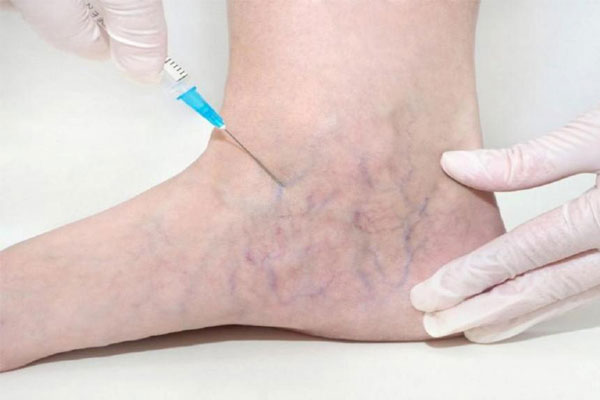 روش‌های درمان واریس عنکبوتی