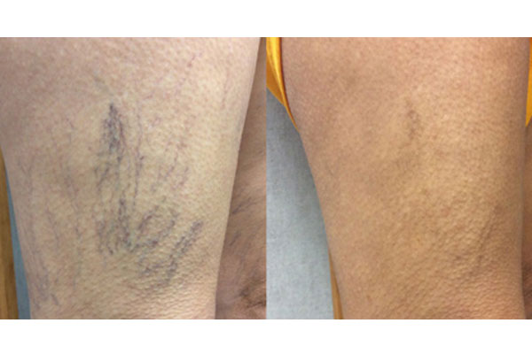 علل و عوامل ایجاد واریس عنکبوتی 