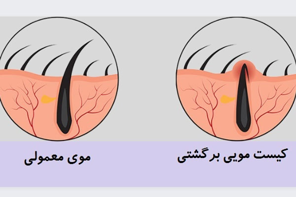 راه های پیشگیری از کیست مویی