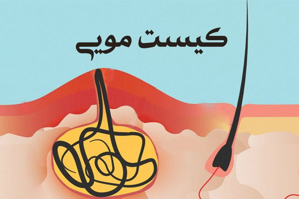 راه های درمان کیست مویی