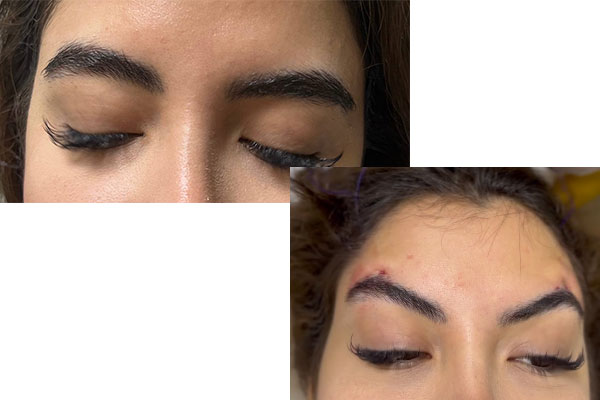 لیفت صورت با نخ چیست؟