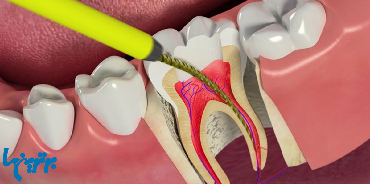 فرق درمان ریشه دندان با عصب کشی