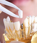 جراحی ایمپلنت دندان در کلینیک دندانپزشکی راحیل
