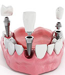 بهترین خدمات ایمپلنت دندان در دندانپزشکی راحیل