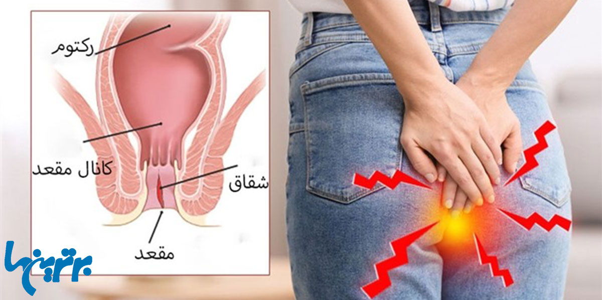 درمان خانگی بیرون زدگی مقعدی