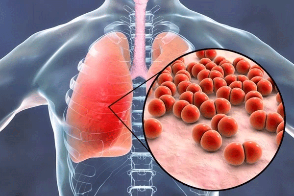درمان عفونت ریه 