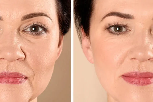 مزایای جوانسازی صورت