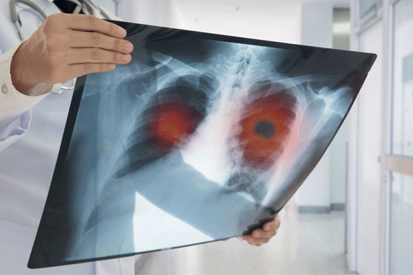 علائم عفونت ریه