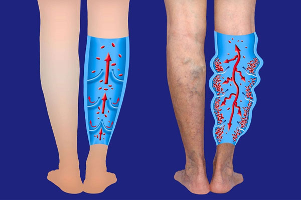 علت بروز واریس