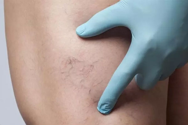 ورزش های مناسب برای واریس