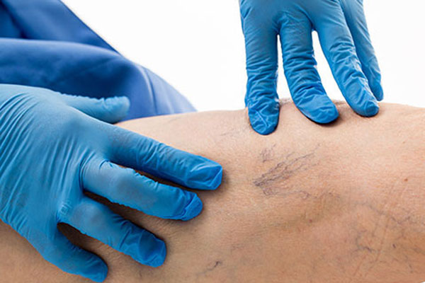 درمان واریس در بارداری