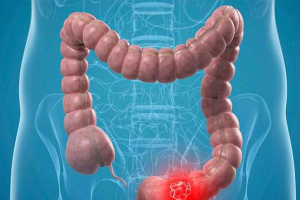 خاکشیر برای همه انواع یبوست