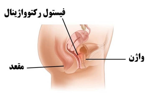 مراقبت های بعد از درمان فیستول واژن 