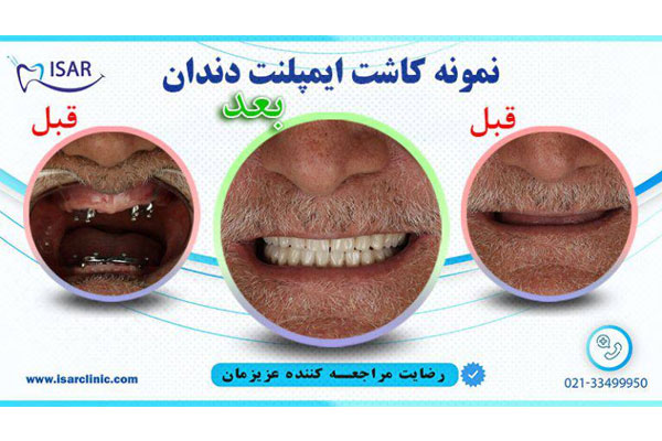 مزایای ایمپلنت دیجیتال دندان