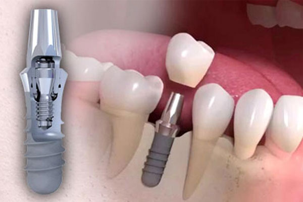 بهترین نوع ایمپلنت کدام است