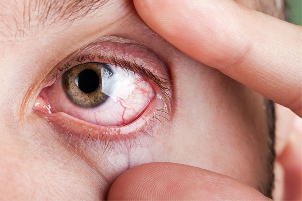 راه های درمانی چشم درد 