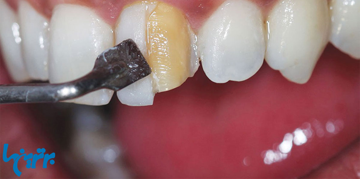 کامپوزیت دندان قبل یا بعد از جراحی بینی