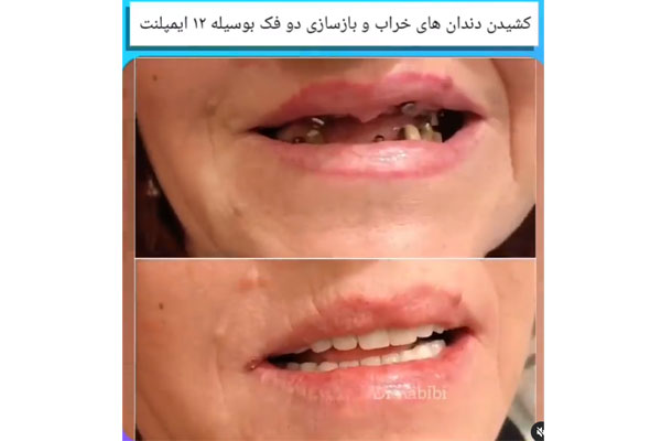 مرکز ایمپلنت زعفرانیه