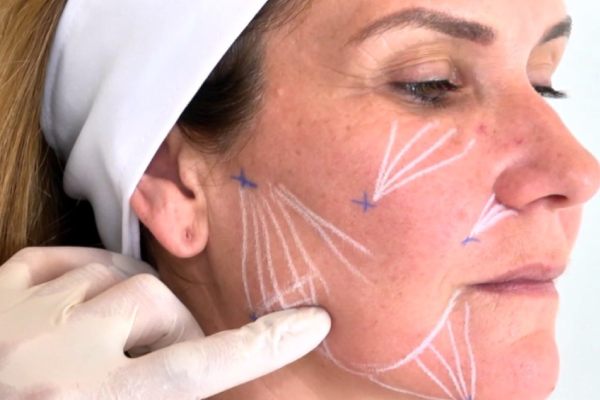 کاندید های مناسب برای لیفت صورت با نخ