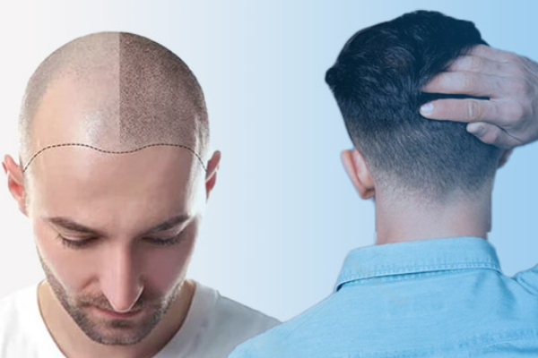 روش های رایج کاشت مو