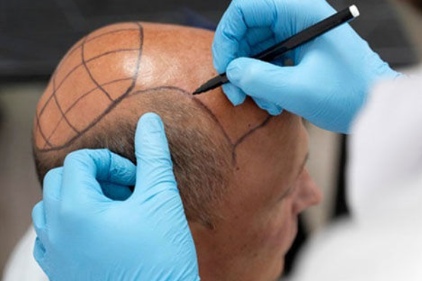 ویژگی های کاشت موی طبیعی و قابل رشد