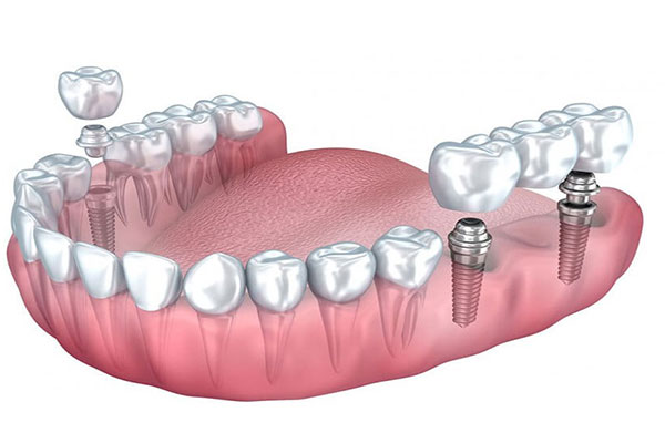عوارض ایمپلنت دندان